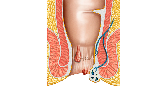 hämorrhoiden arzt wien